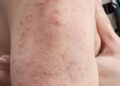 Dengue Fever in Edo
