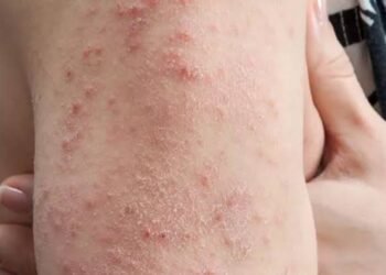 Dengue Fever in Edo