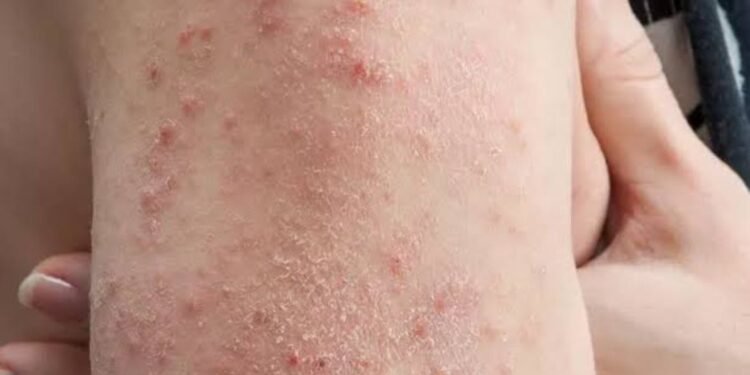 Dengue Fever in Edo