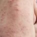 Dengue Fever in Edo