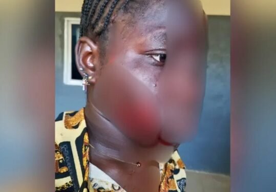 Outrage in Taraba over alleged facial disfigurement of teenager